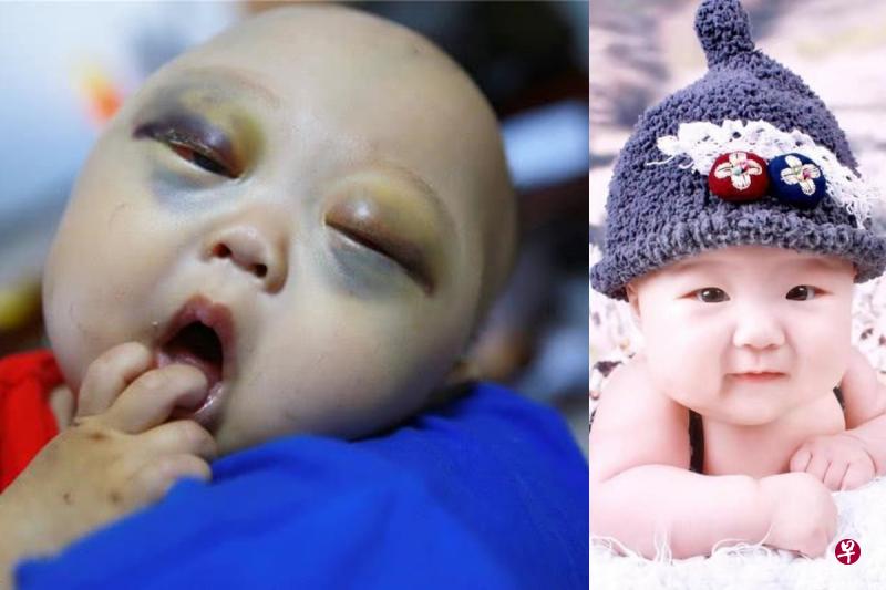 患癌女宝宝双眼肿胀淤血,眼球突出如乒乓球(左图);右图为女宝宝患病前的可爱模样。 患癌女宝宝双眼肿胀淤血,眼球突出如乒乓球(左图);右图为女宝宝患病前的可爱模样。