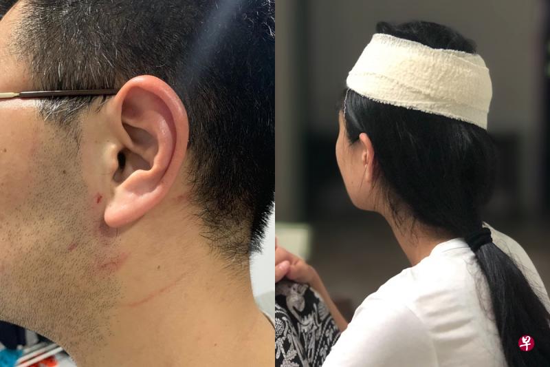 前空姐(右)称19日晚上头部被医生老公推撞地板而受伤;医生则指自己也被太太抓伤,脖子上有抓痕。 前空姐(右)称19日晚上头部被医生老公推撞地板而受伤;医生则指自己也被太太抓伤,脖子上有抓痕。