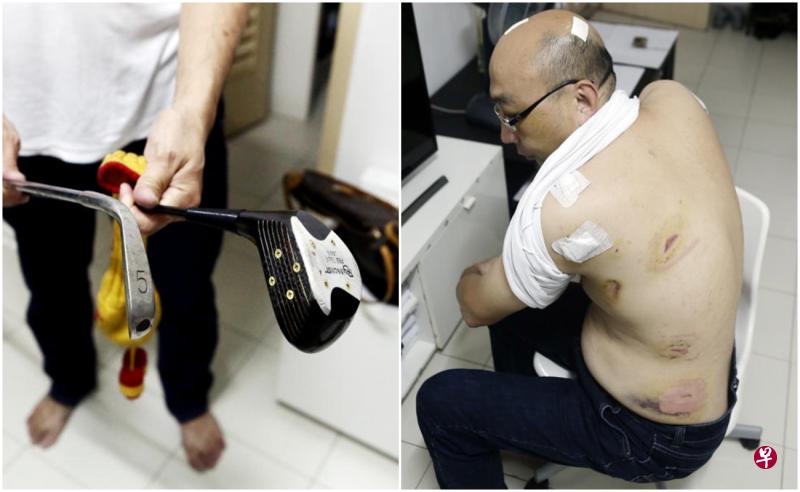 钟正业说,他的头部相信是被高尔夫球杆打伤,背部也伤痕累累。(陈渊庄摄) 钟正业说,他的头部相信是被高尔夫球杆打伤,背部也伤痕累累。(陈渊庄摄)