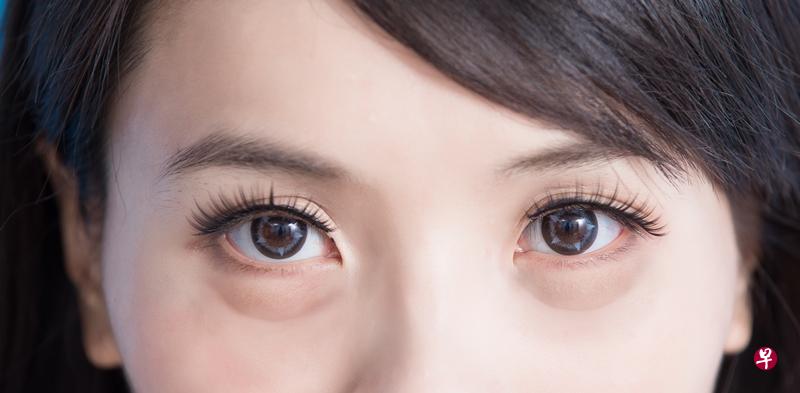 双眼浮肿很常见,什么情况下需求诊?(iStock) 双眼浮肿很常见,什么情况下需求诊?(iStock)