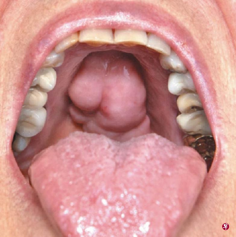 上颚硬腭中缝隆凸 上颚硬腭中缝隆凸