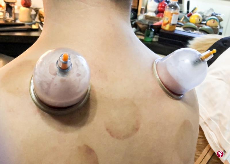 拔罐放血后的舒畅与被人一针见血指出了某些错误后的恍然大悟,有异曲同工之妙。(作者提供) 拔罐放血后的舒畅与被人一针见血指出了某些错误后的恍然大悟,有异曲同工之妙。(作者提供)