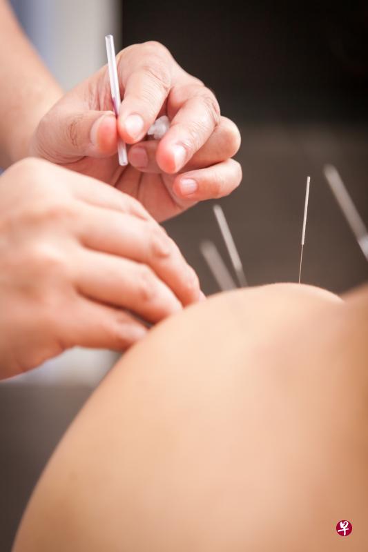 拳器道提供全方位中医治疗,包括针灸。(拳器道提供) 拳器道提供全方位中医治疗,包括针灸。(拳器道提供)