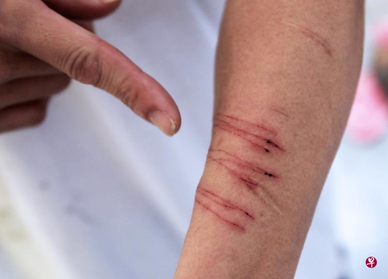 高级临床心理医生朱珍妮分析,自残会让他们认为这些疼痛可以分散情绪上的痛苦,但问题依然存在。(档案照)
高级临床心理医生朱珍妮分析,自残会让他们认为这些疼痛可以分散情绪上的痛苦,但问题依然存在。(档案照)