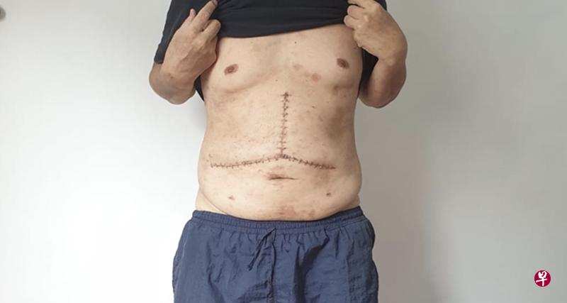 59岁工程师陈明亮接受手术后,如今在康复中。(受访者提供) 59岁工程师陈明亮接受手术后,如今在康复中。(受访者提供)