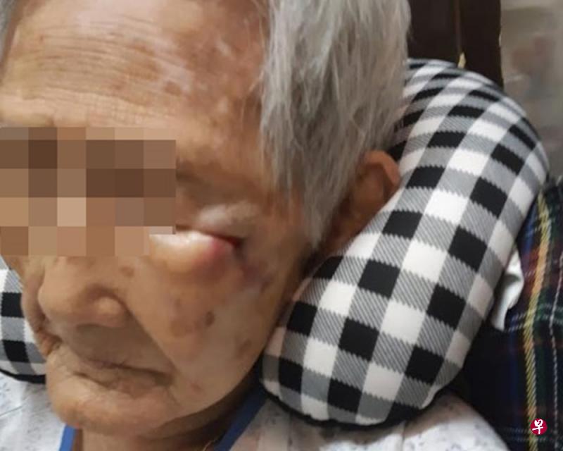 女士指母亲在厕所摔倒后,左眼角肿胀流血,隔天还发炎发烧须送院留医长达八天。(受访者提供) 女士指母亲在厕所摔倒后,左眼角肿胀流血,隔天还发炎发烧须送院留医长达八天。(受访者提供)
