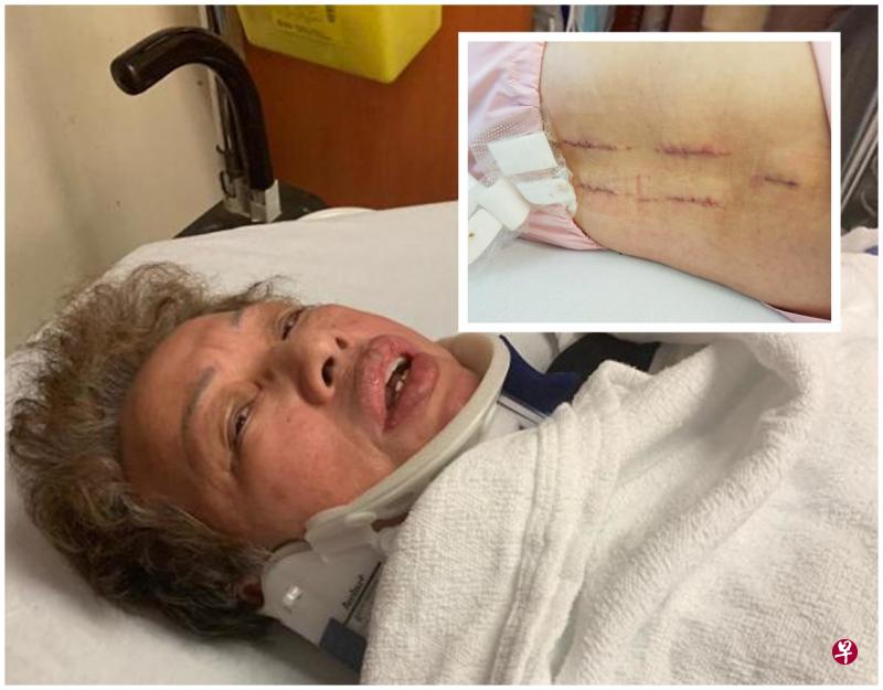 因伤及脊椎,潘丽容得动手术,植入八根螺丝固定脊椎。(受访者提供) 因伤及脊椎,潘丽容得动手术,植入八根螺丝固定脊椎。(受访者提供)