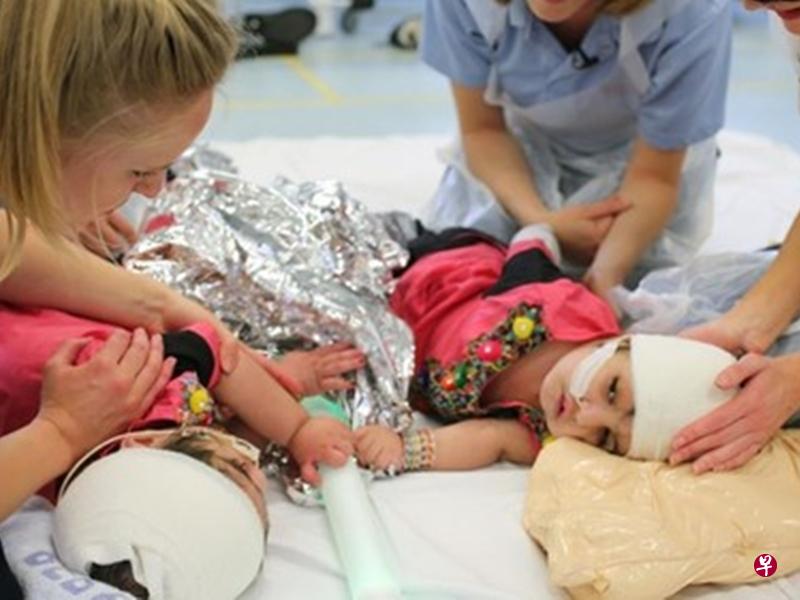 2017年1月出生的一对巴基斯坦颅部联胎分体成功。(互联网) 2017年1月出生的一对巴基斯坦颅部联胎分体成功。(互联网)