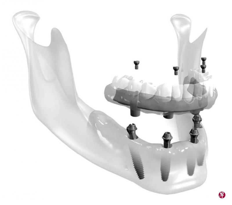 下颚置入4到5颗种植体,帮助患者修复和重展自信笑容。 下颚置入4到5颗种植体,帮助患者修复和重展自信笑容。