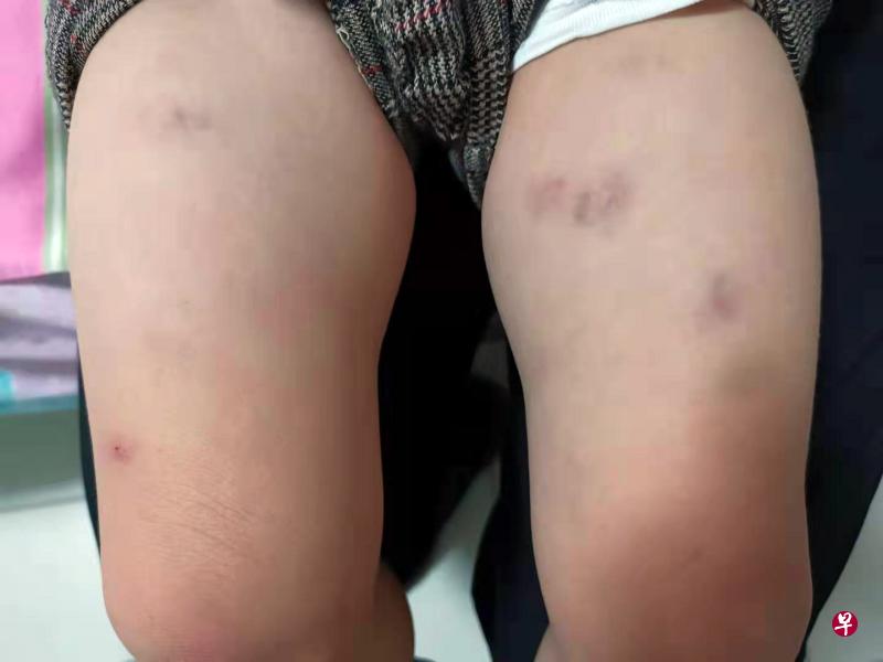 赵姓父亲说,自己将儿子接回家后,妻子发现儿子的双腿内侧出现五六个相信由掐痕造成的淤青。由于发照片给幼儿园后并未获得幼儿园的回复,因此报警处理。(受访者提供) 赵姓父亲说,自己将儿子接回家后,妻子发现儿子的双腿内侧出现五六个相信由掐痕造成的淤青。由于发照片给幼儿园后并未获得幼儿园的回复,因此报警处理。(受访者提供)