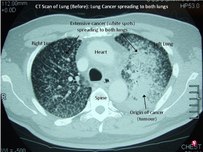 数据显示,死于癌症的人数是死于心血管疾病人数的两倍,癌症已成为发达国家人们面临的第一大健康威胁。图为一名肺癌病患的癌细胞X光扫描。(档案照) 数据显示,死于癌症的人数是死于心血管疾病人数的两倍,癌症已成为发达国家人们面临的第一大健康威胁。图为一名肺癌病患的癌细胞X光扫描。(档案照)