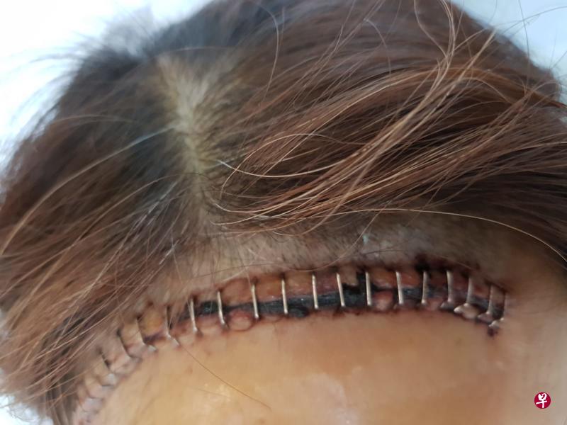 杨女士动手术清除淤血后,头颅钉了30钉。(受访者提供) 杨女士动手术清除淤血后,头颅钉了30钉。(受访者提供)