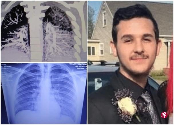 美国19岁少年梅奧(右)的肺部积聚固化烟油。(互联网)
美国19岁少年梅奧(右)的肺部积聚固化烟油。(互联网)