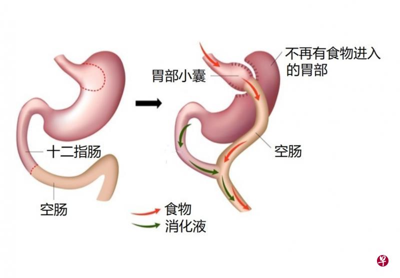 胃绕道手术 胃绕道手术