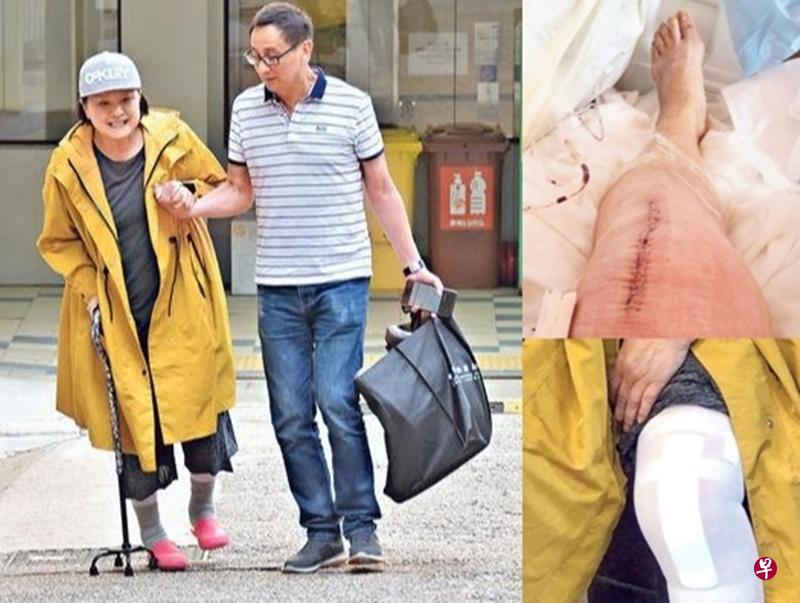 黄淑仪在丈夫徐景清陪同下出院。她的左膝盖手术后留下长长的疤痕(右图)。(互联网) 黄淑仪在丈夫徐景清陪同下出院。她的左膝盖手术后留下长长的疤痕(右图)。(互联网)