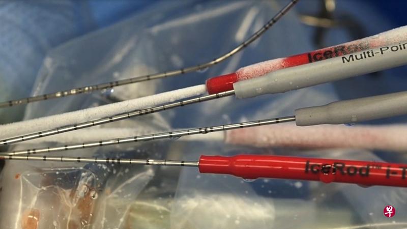 医生会把数个有冷冻功能的探针插入病人体内的前列腺,注入氩气的探针表面冷得结霜。另一些灰色的仪器则用于测量温度。(新加坡中央医院提供) 医生会把数个有冷冻功能的探针插入病人体内的前列腺,注入氩气的探针表面冷得结霜。另一些灰色的仪器则用于测量温度。(新加坡中央医院提供)