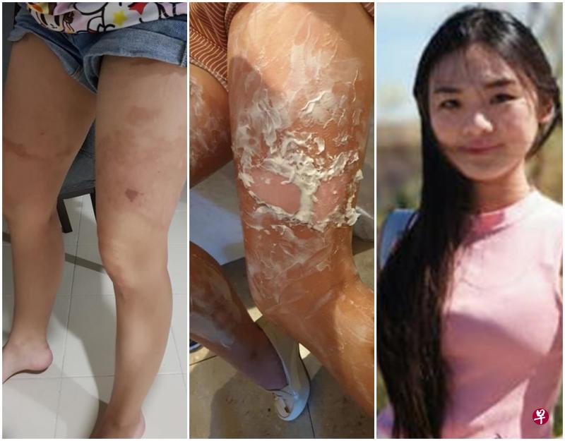张芯瑜被烫得皮开肉绽,餐馆服务员过后找来药膏涂在她的大腿上。(受访者提供) 张芯瑜被烫得皮开肉绽,餐馆服务员过后找来药膏涂在她的大腿上。(受访者提供)