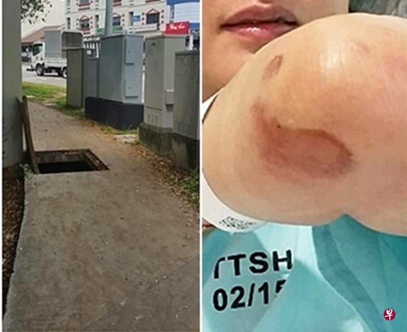 曾慧萍的左手多处擦伤脱皮。( 受访者提供) 曾慧萍的左手多处擦伤脱皮。( 受访者提供)