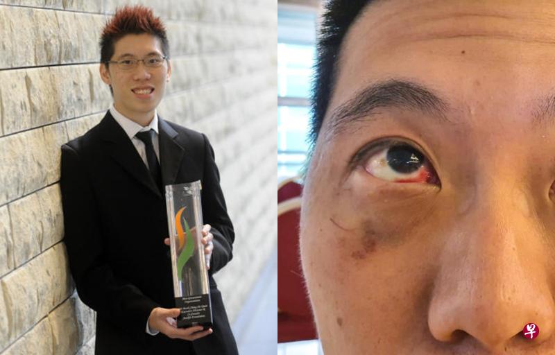 (左图)钟金泉曾在2016年获颁“英女王年轻领袖”奖,当时是第一位获颁此殊荣的新加坡人。(档案照)(右图)钟金泉今早眼睛出血,已赶往医院求医。(受访者提供) (左图)钟金泉曾在2016年获颁“英女王年轻领袖”奖,当时是第一位获颁此殊荣的新加坡人。(档案照)(右图)钟金泉今早眼睛出血,已赶往医院求医。(受访者提供)