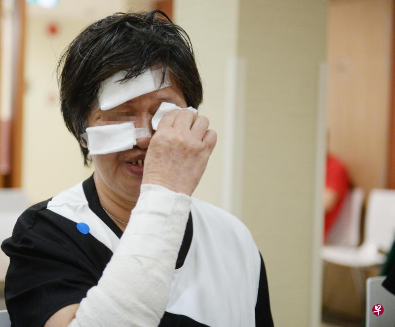 周玉叶的脸部和肩膀二级烧伤,医生表示会留疤。(潘丰源 摄影) 周玉叶的脸部和肩膀二级烧伤,医生表示会留疤。(潘丰源 摄影)