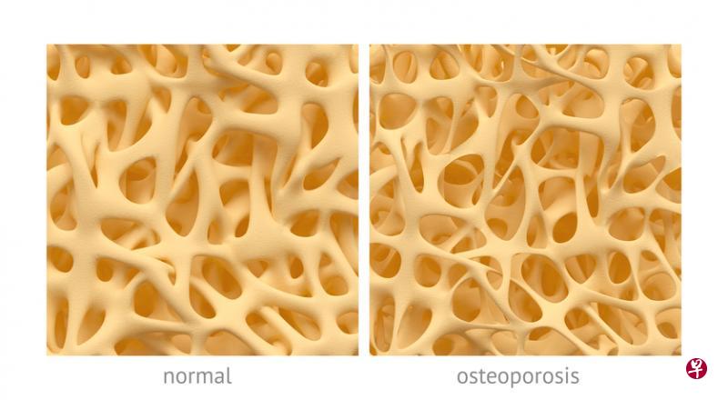 正常骨质密密实实。有了年纪之后,骨质变得疏松。(iStock图片) 正常骨质密密实实。有了年纪之后,骨质变得疏松。(iStock图片)