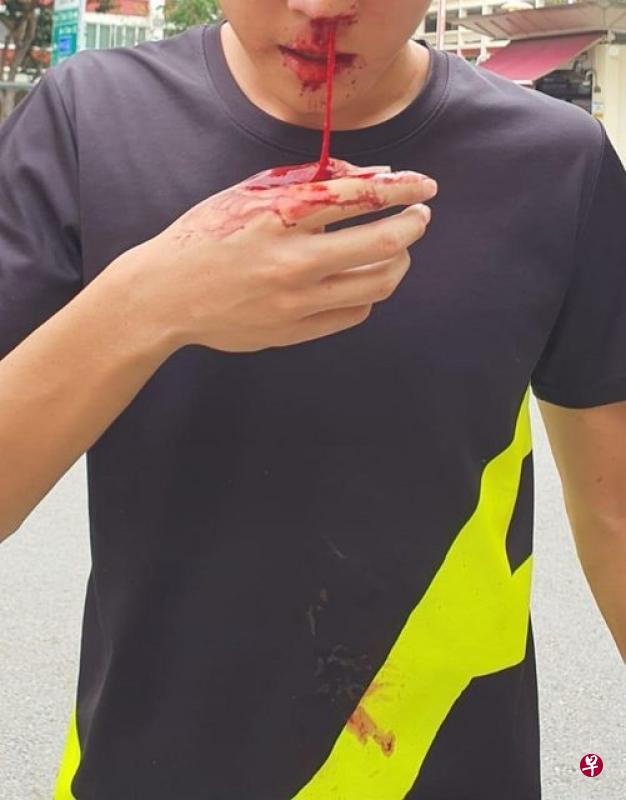 少年鼻血流不止。(取自HardwareZone) 少年鼻血流不止。(取自HardwareZone)