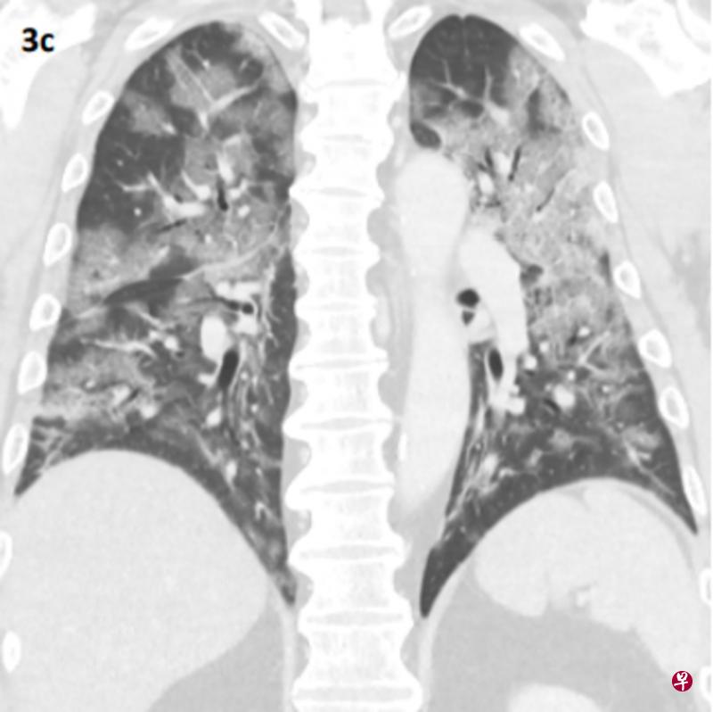 本地一名53岁冠病病患入院初期的电脑断层扫描影像显示,他的肺部出现磨玻璃影和形同“碎石路”的细线阴影,这些阴影将随着病患的康复程度逐渐消退。(新加坡医疗期刊) 本地一名53岁冠病病患入院初期的电脑断层扫描影像显示,他的肺部出现磨玻璃影和形同“碎石路”的细线阴影,这些阴影将随着病患的康复程度逐渐消退。(新加坡医疗期刊)