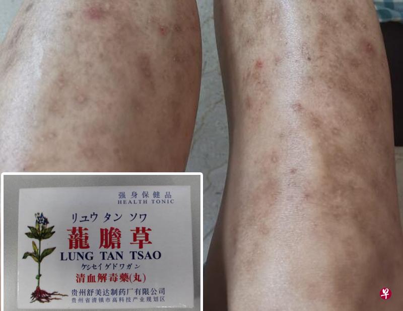 苏丽丽六年来饱受湿疹问题困扰，整个腿都是湿疹，因此在朋友介绍下服用名为“茏胆草清血解毒药”的药物，却引发副作用。（受访者提供）