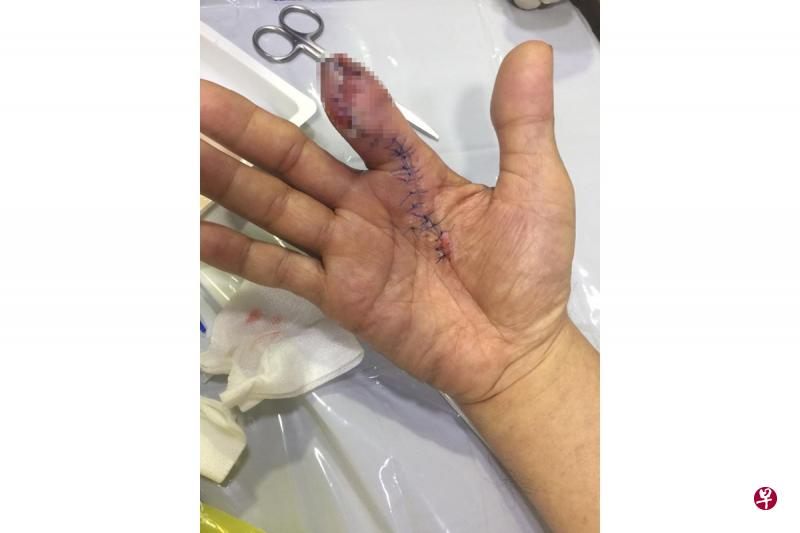 网民称朋友食指的第一节过后相信因遭到食肉菌侵噬,结果需要被切除。(取自面簿) 网民称朋友食指的第一节过后相信因遭到食肉菌侵噬,结果需要被切除。(取自面簿)