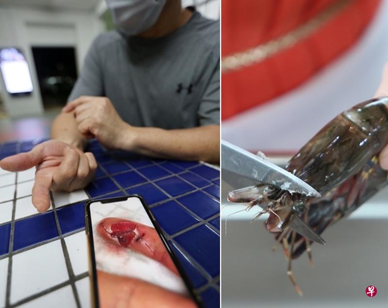 陈先生住院开刀切肉除菌。(受访者提供) 陈先生住院开刀切肉除菌。(受访者提供)