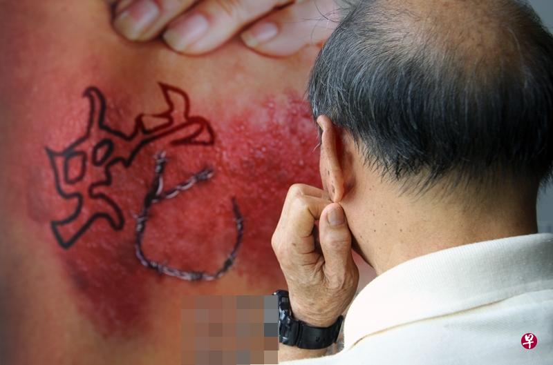 带状疱疹的症状以长红斑、水疱、疼痛为主。(档案照) 带状疱疹的症状以长红斑、水疱、疼痛为主。(档案照)