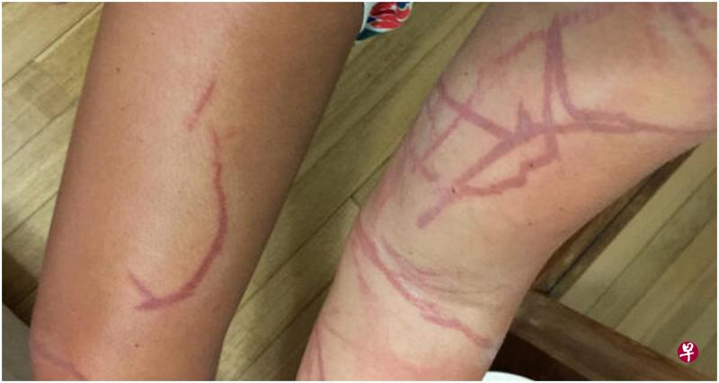 一名澳大利亚女子三月在东海岸海边游泳时也被水母蛰伤。(Jade Dyson提供) 一名澳大利亚女子三月在东海岸海边游泳时也被水母蛰伤。(Jade Dyson提供)