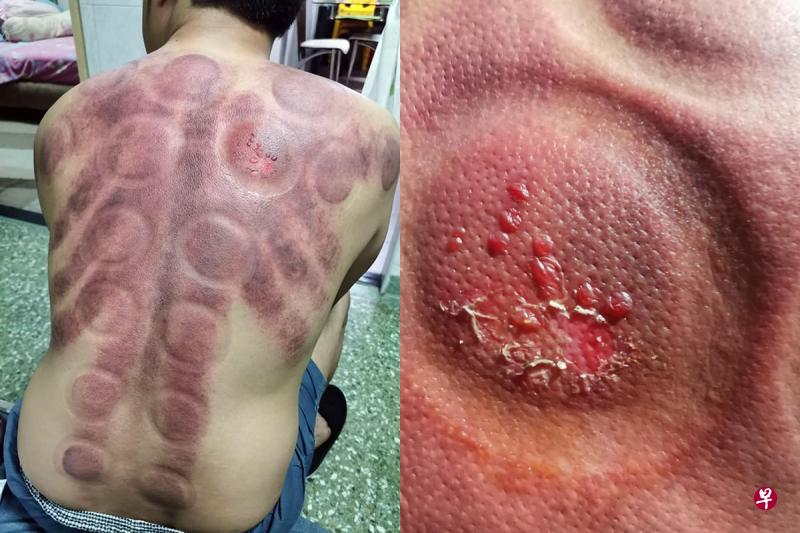 男厨师约翰申诉,拔罐时自己背部遭灼伤,伤口起水泡,疼痛难忍。(取自面簿) 男厨师约翰申诉,拔罐时自己背部遭灼伤,伤口起水泡,疼痛难忍。(取自面簿)