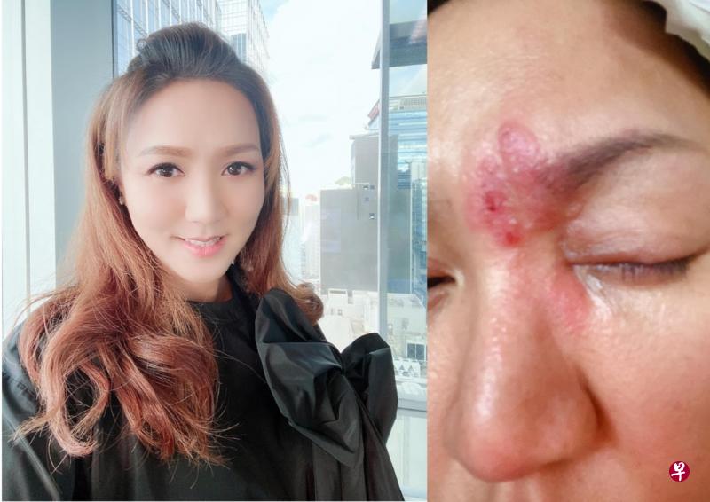 黎瑞恩的左眼上方处长了带状疱疹,之前还忍痛排练舞台剧。(面簿图) 黎瑞恩的左眼上方处长了带状疱疹,之前还忍痛排练舞台剧。(面簿图)