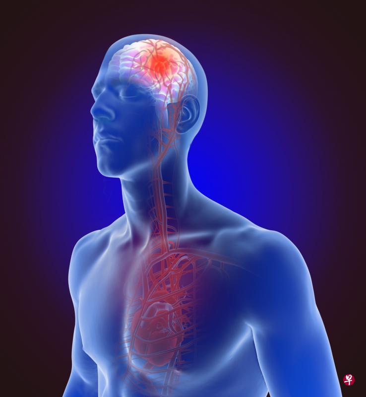 不要忽略心房颤动，它是导致缺血性中风的危险因子。（iStock图片）
