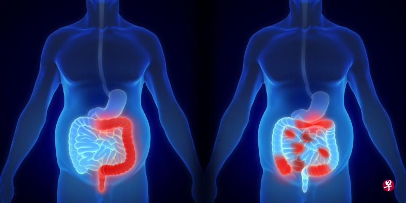 溃疡性结肠炎(左)与克罗恩病(右)是两种常见的慢性肠炎。(iStock图片) 溃疡性结肠炎(左)与克罗恩病(右)是两种常见的慢性肠炎。(iStock图片)
