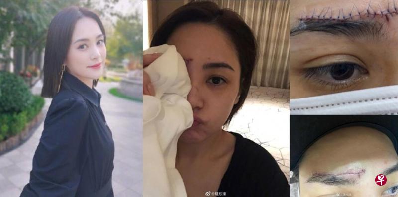 钟欣潼公开伤口照,还自己一个清白。其伤口跟眉毛一样长,左眉上方和鼻梁处也有小伤口(右排图)。(微博图) 钟欣潼公开伤口照,还自己一个清白。其伤口跟眉毛一样长,左眉上方和鼻梁处也有小伤口(右排图)。(微博图)