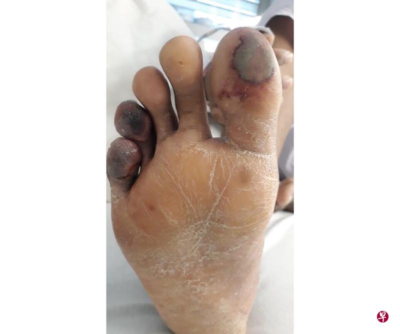 冠病病患科法耶入院三天后,右脚脚指头开始发黑,来自陈笃生医院的团队进行扫描后,发现他的腿部有血栓,后来更发现他主动脉出现血栓,立即为他动手术清除腿部血栓,并在主动脉安装覆膜支架。(陈笃生医院提供) 冠病病患科法耶入院三天后,右脚脚指头开始发黑,来自陈笃生医院的团队进行扫描后,发现他的腿部有血栓,后来更发现他主动脉出现血栓,立即为他动手术清除腿部血栓,并在主动脉安装覆膜支架。(陈笃生医院提供)