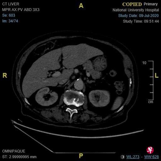 图A:左肝长了一颗原发性肝癌。(作者提供) 图A:左肝长了一颗原发性肝癌。(作者提供)