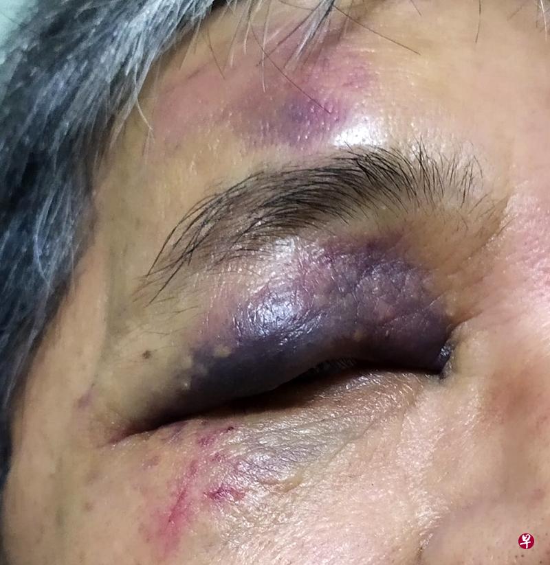 德士司机右眼被打至淤青。(受访者提供) 德士司机右眼被打至淤青。(受访者提供)