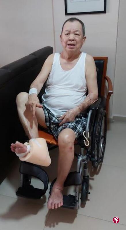 唐琥透露护士一周两次上门清洗脚部伤口。(受访者提供) 唐琥透露护士一周两次上门清洗脚部伤口。(受访者提供)