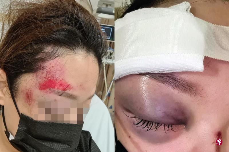 左图:翻车倒地后,女网友的右额头和鼻子都擦伤,脑部也有血液凝块。右图:女网友手脚多处擦伤,右眼也因跌到变成“熊猫眼”。(取自面簿) 左图:翻车倒地后,女网友的右额头和鼻子都擦伤,脑部也有血液凝块。右图:女网友手脚多处擦伤,右眼也因跌到变成“熊猫眼”。(取自面簿)