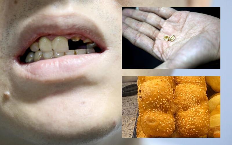 谢先生的两颗牙齿在吃麻煎的时候被磕断,今后可能必须戴假牙,令他十分不满。 谢先生的两颗牙齿在吃麻煎的时候被磕断,今后可能必须戴假牙,令他十分不满。