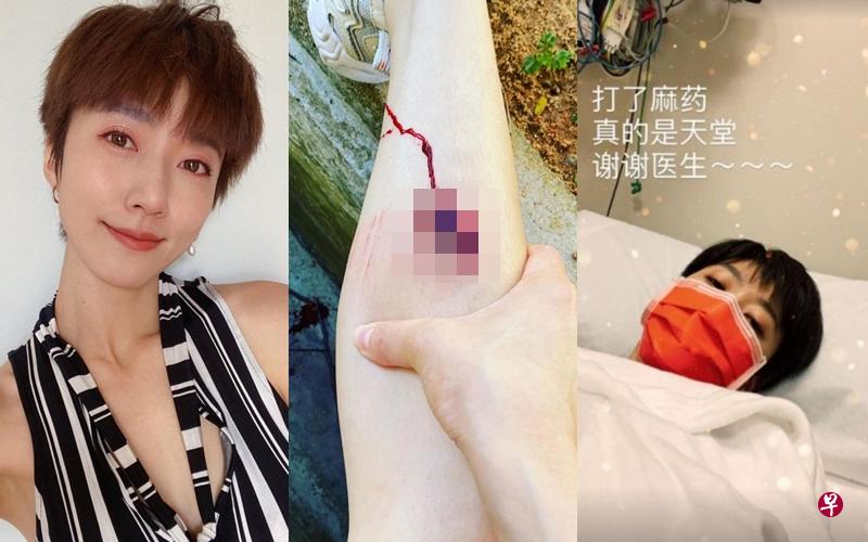 庞蕾馨的右腿伤口颇深(中图),缝了数针。(庞蕾馨IG图) 庞蕾馨的右腿伤口颇深(中图),缝了数针。(庞蕾馨IG图)