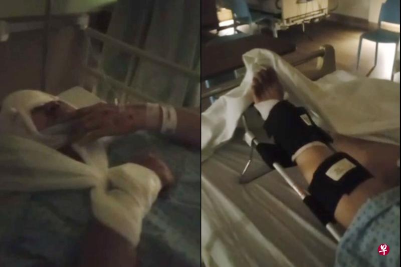 事发当天,胡慧芳情况一度危急,被进加护病房。她的左小腿骨折进行手术后,用支架加以固定。(受访者提供) 事发当天,胡慧芳情况一度危急,被进加护病房。她的左小腿骨折进行手术后,用支架加以固定。(受访者提供)