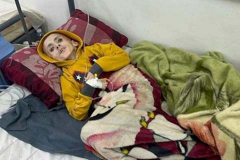 加沙男童亚桑因严重营养不良和药物不足，2024年3月4日在医院去世，死时骨瘦如柴。（路透社）